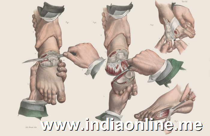 Amputation of carious toes